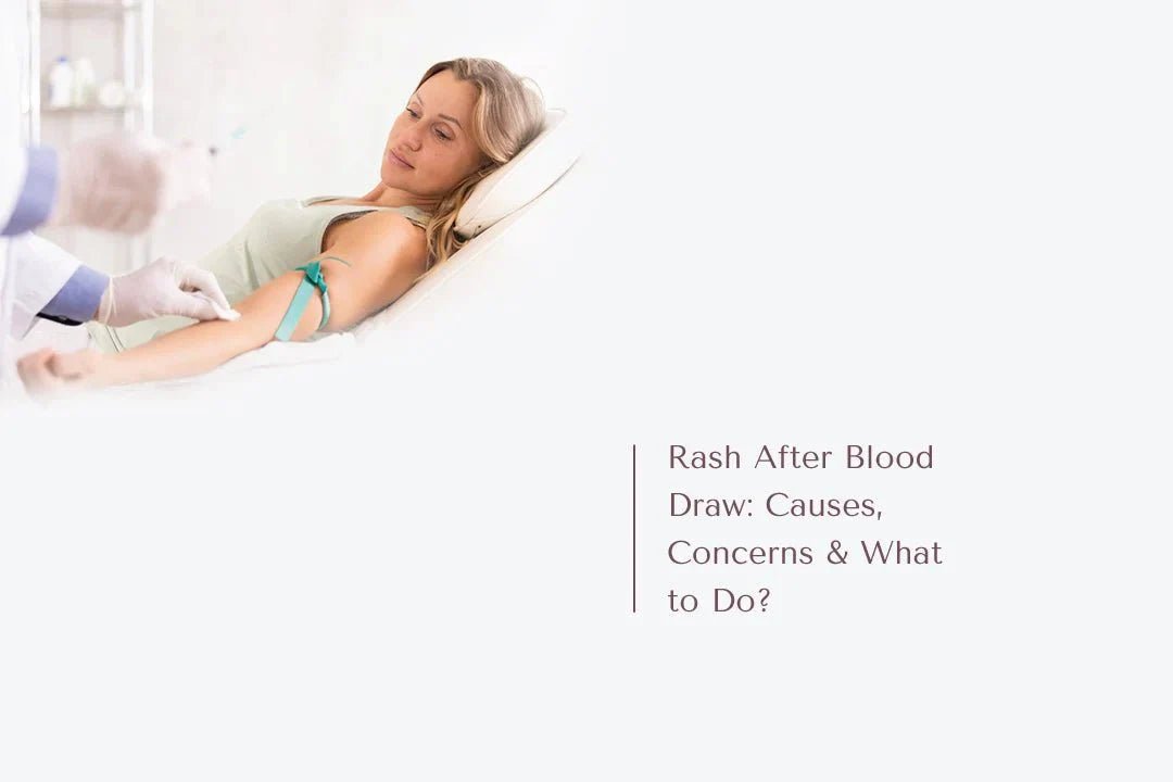 Rash After Blood Draw: Causes, Concerns & What to Do? - The National Blood Test Clinic